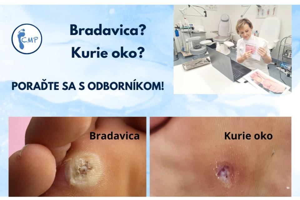 Kurie oko alebo bradavica