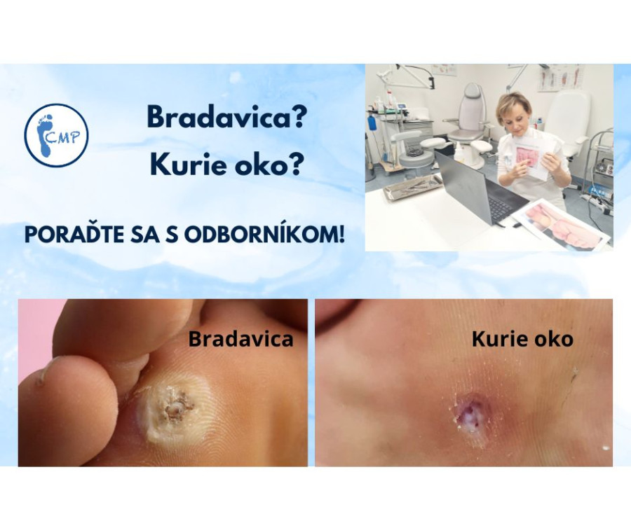 Kurie oko alebo bradavica