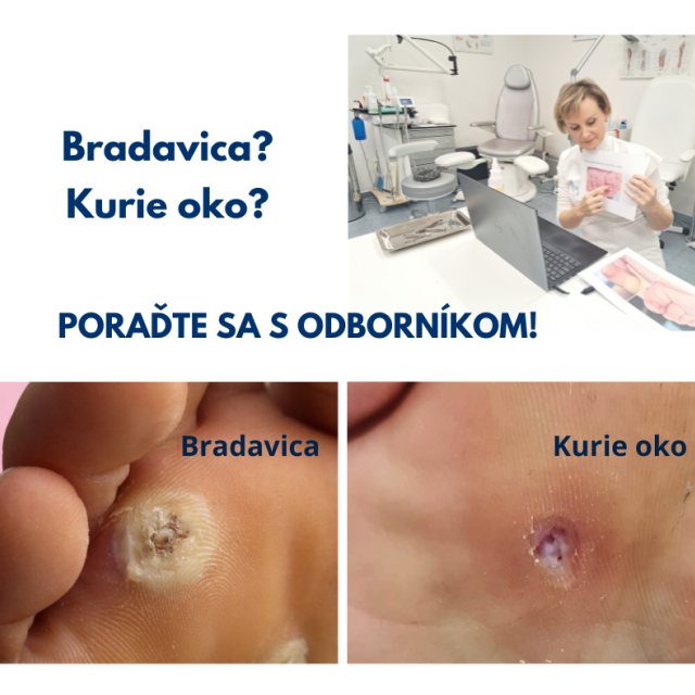 Kurie oko alebo bradavica