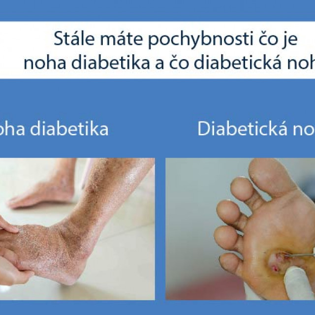 Stále máte pochybnosti čo je noha diabetika a čo diabetická noha?