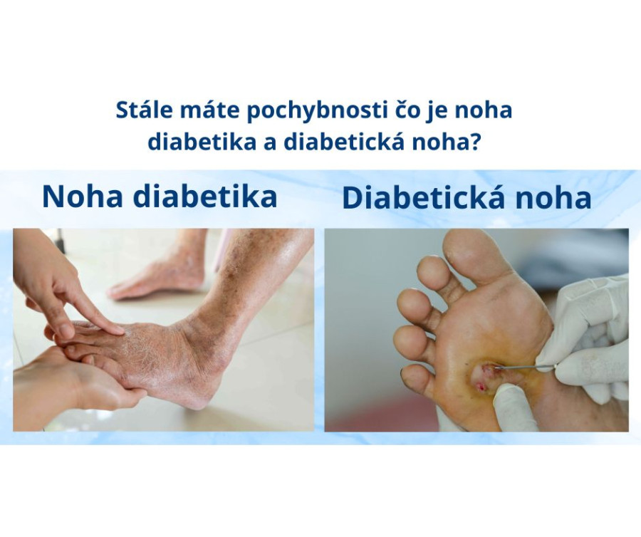 Stále máte pochybnosti čo je noha diabetika a čo diabetická noha?