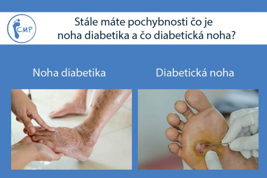 Stále máte pochybnosti čo je noha diabetika a čo diabetická noha?