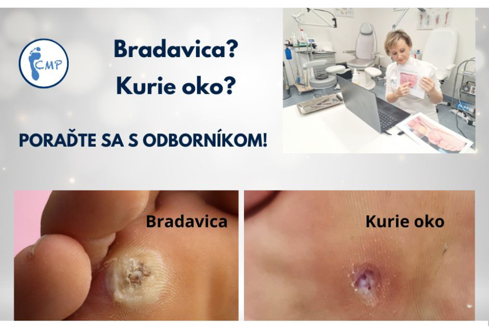 Kurie oko alebo bradavica